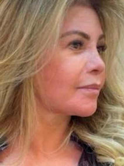 Depois: Blefaroplastia, Deep Plane e Deep Neck