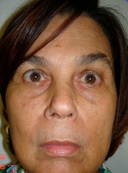 Antes: Deep Neck, vista frontal