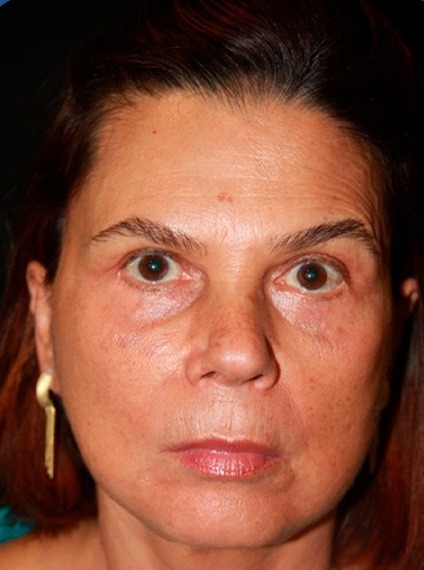 Depois: Deep Neck, vista frontal