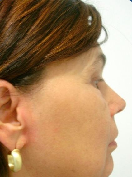 Antes: Deep Neck, vista de perfil