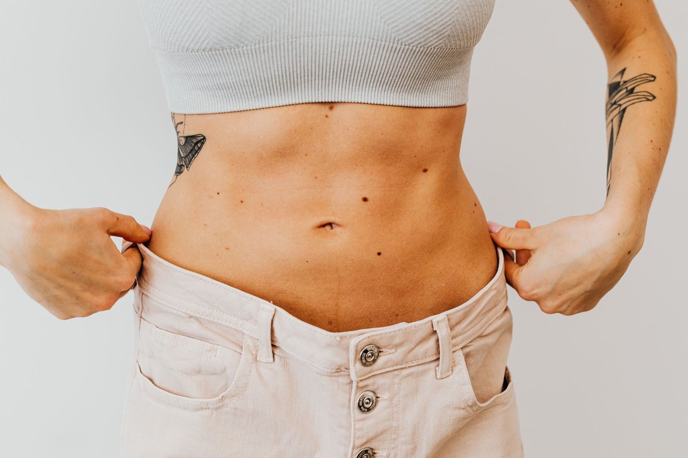 Miniabdominoplastia